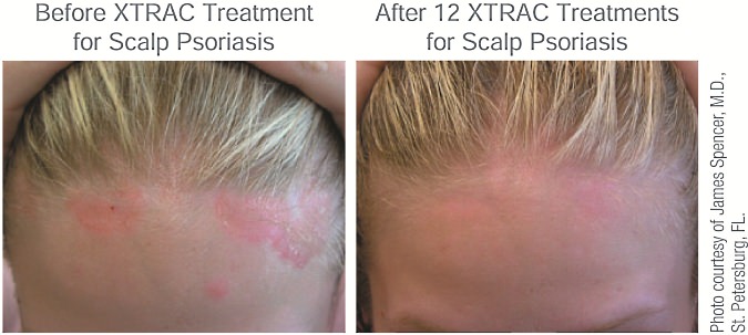Before XTRAC Treatment and After 12 XTRAC Treatment for Scalp Psoriasis