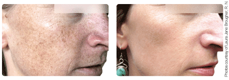 Before and After Treatment of Face
