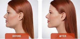 Kybella before and after