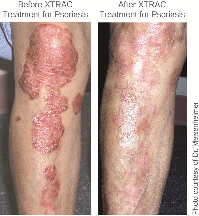 Before XTRAC Treatment and After XTRAC Treatment for Psoriasis