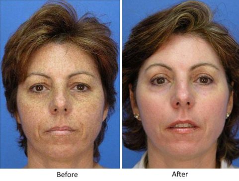 Laser Resurfacing Before and After