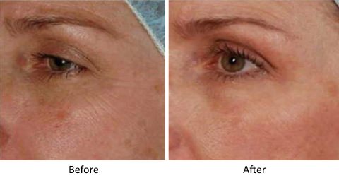 Laser Resurfacing Before and After