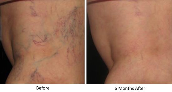 Before and After Sclerotherapy