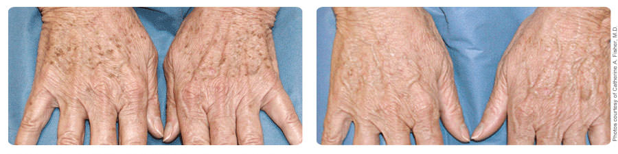 Before and After Treatment of Hands