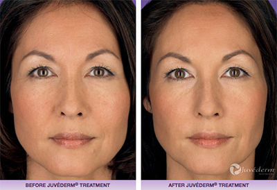 juvederm before after